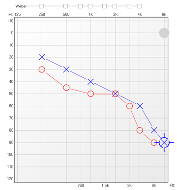 Audiogram czyli wynik badania słuchu ukazujący niedosłuch odbiorczy charakterystyczny dla osób starszych oraz seniorów.